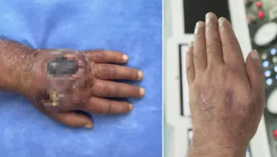 Doktorlar da şaşırdı: Hırsız öyle bir ısırdı ki; literatüre girmeye aday!