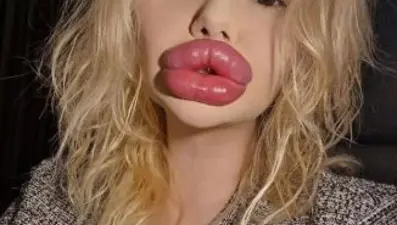 Dünyanın en büyük dudaklı kadını: Sağlık çalışanları onu tedavi etmeyi reddediyor