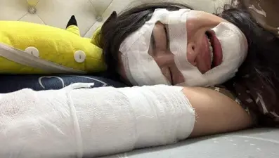 Doğum gününde facia: Elinde patlayan balon yüzünü yaktı!