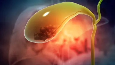 Safra kesesi taşı neden olur, nasıl tedavi edilir? (Safra kesesi taşı belirtileri nelerdir?)