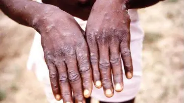 DSÖ açıkladı: Afrika'da bu yıl 30 bine yakın M çiçeği vakası görüldü