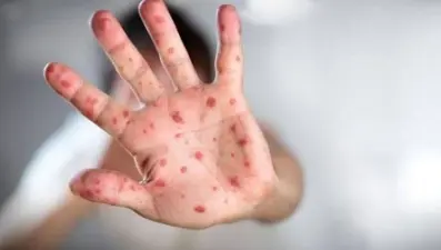 El-ayak-ağız hastalığı çocukları tehdit ediyor!