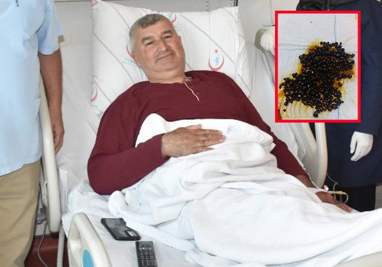 Doktorlar bile şaşırdı: Hepsi safra kesesinden çıkarıldı