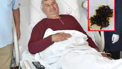 Doktorlar bile şaşırdı: Hepsi safra kesesinden çıkarıldı