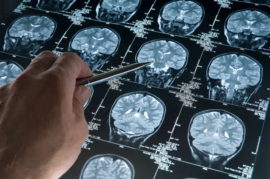 Beyin tümörü riskiniz var mı? 30 saniyelik el testi 3
