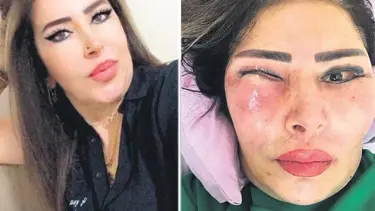 Yüz gerdirme ameliyatı hayatını kabusa çevirdi: Gözünün içinde et çıktı