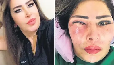 Yüz gerdirme ameliyatı hayatını kabusa çevirdi: Gözünün içinde et çıktı