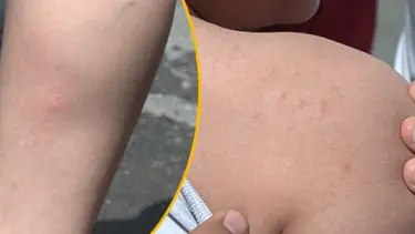 “Aedes Aegypti” tedirginliği artıyor | Bilim Kurulu Üyesi Alper Şener’den “kolonya sürmeyin” uyarısı