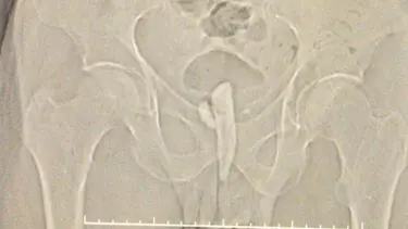 İdrar kesesinden 8 santimlik odun parçası çıktı