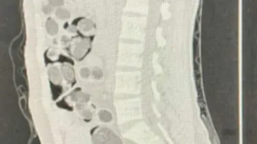 Yabancı uyruklu yolcunun midesinden 219 paket uyuşturucu çıktı