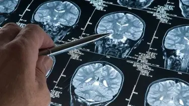 Alzheimer beyne 25 yıl öncesinde yerleşiyor