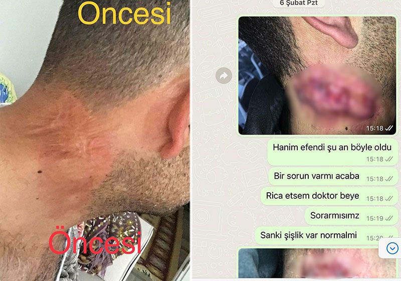 Lazer hayatını kararttı: Tedavi 30 yıl geriye götürdü
