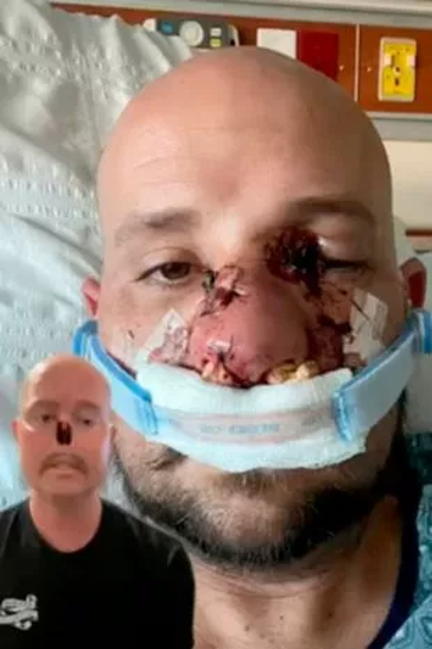 Milyonda 2 kişide görülüyor: Grip oldu, burnunu kaybetti 4