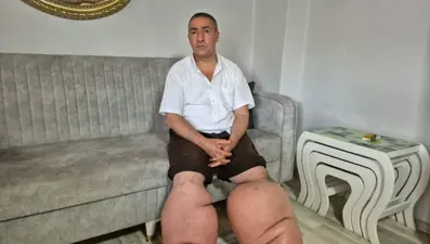 Yüksek ateş şikayetiyle hastaneye gitti: 15 yıldır bu hastalıkla savaşıyor