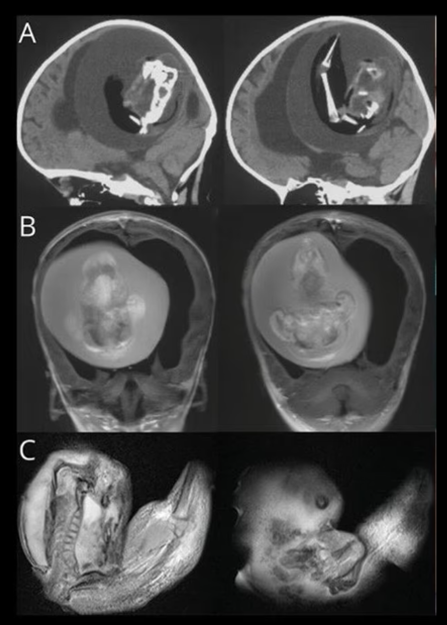 Bir yaşındaki kız çocuğunun beyninden doğmamış ikizi çıkarıldı 