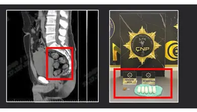 Tomografide şok eden görüntü: Midesinden çıkarıldı