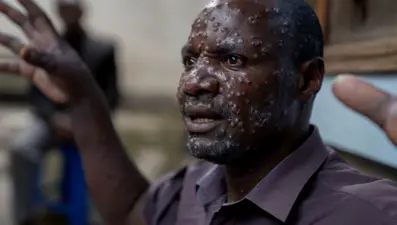 Dünya yeni bir pandemi eşiğinde: Maymun çiçeği virüsü hakkında merak edilenler