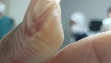 5 dakika geçti patladı, vücudunun yüzde 30'u yandı. Kâbusu yaşadı, acı içinde kaldı