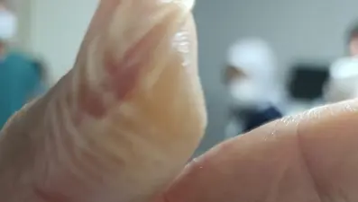 5 dakika geçti patladı, vücudunun yüzde 30'u yandı. Kâbusu yaşadı, acı içinde kaldı