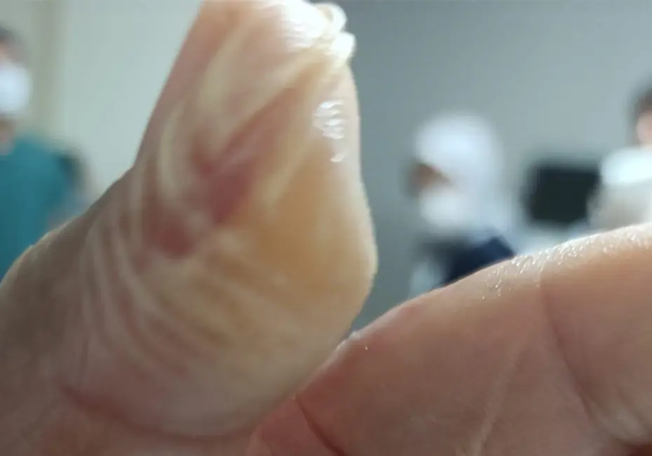 5 dakika geçti patladı, vücudunun yüzde 30’u yandı. Kâbusu yaşadı, acı içinde kaldı