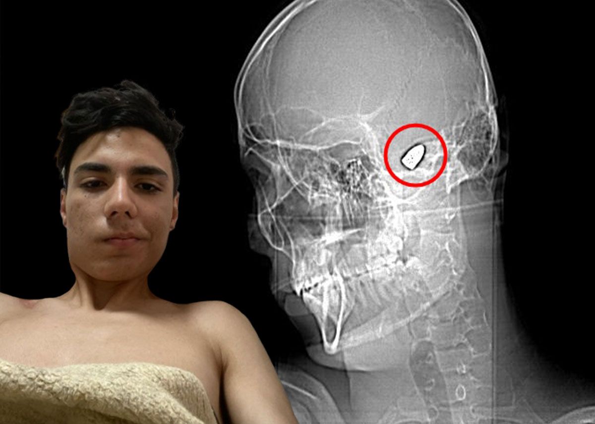 Kafasının içinde patlamaya hazır bomba ile dolaşıyor