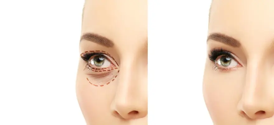 Yüz estetiğinde doğru bilinen 10 yanlış (Beklentileriniz ne kadar gerçekçi?) 8