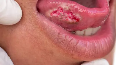 Migren ağrısı 4. evre kanser çıktı, dilinin yüzde 80'i alındı: 36 yaşındaki kadının önemsemediği 4 belirti