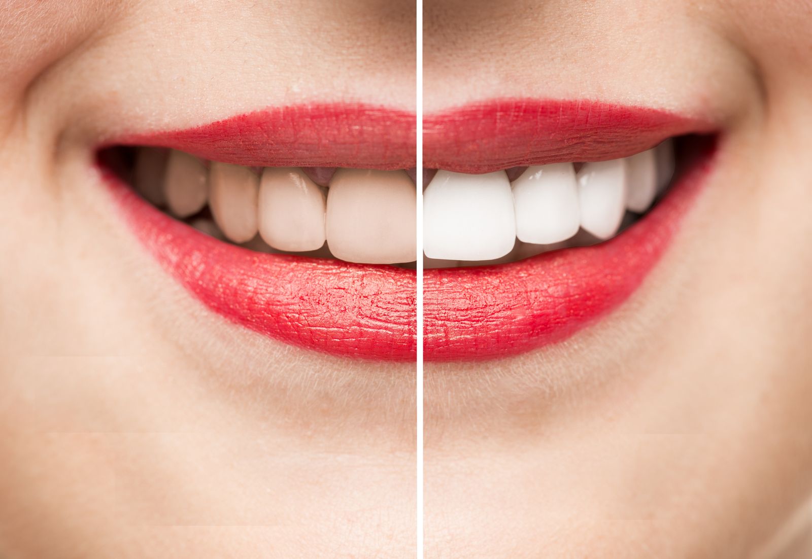 Diş beyazlatma (Bleaching) nedir? (Diş beyazlatma yöntemleri nelerdir?)