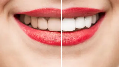 Diş beyazlatma (Bleaching) nedir? (Diş beyazlatma yöntemleri nelerdir?)