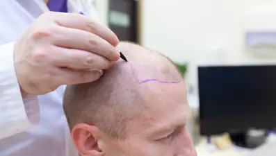 “Saç ekimi hastane ortamında yapılmalı” (İstanbul’da her gün 5 bin saç ekimi yapılıyor)