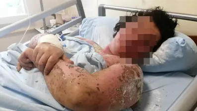 Yanlış antibiyotik kullanımı hayatını zindana çevirdi