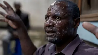 M çiçeği salgınında korkutan artış: Sierra Leone'de virüs patladı