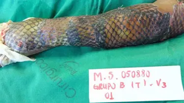 Tıp dünyası bu tedaviyi konuşuyor (Tilapia balığı ile yanık tedavisi)