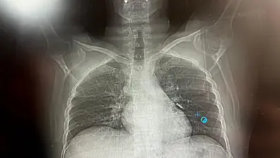 İmplant vidası ciğerine kaçan hasta ölümden döndü