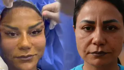 220 bin TL kredi çekip, ip askı ve dolgu yaptırdı: Estetik sonrası hayatı kâbusa döndü