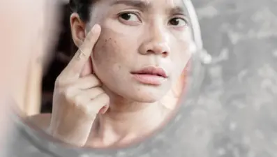 Güneş lekesine ne iyi gelir? Güneş lekesi nasıl geçer?