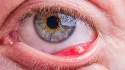 Arpacık nedir? Neden çıkar? Nasıl geçer?