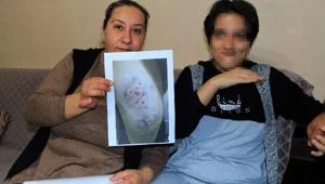 Adana'da otizmli kızın rehabilitasyon merkezinde darp edildiği iddiası Adana'da otizmli kızın rehabilitasyon merkezinde darp edildiği iddiası