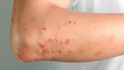 İSTAHED: “Şarbon zamanında tedavi edilmediğinde ölüme yol açar!”