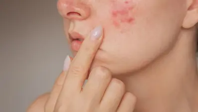 Harvardlı uzman açıkladı: Karaciğer hastalığının 5 cilt belirtisi