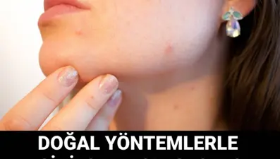 Doğal yöntemlerle sivilce nasıl geçer? Sivilceyi geçiren yöntemler
