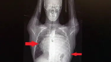 İstanbul'da doktorları bile şaşıran vaka! Kalbi 12 santim sağa kaydı