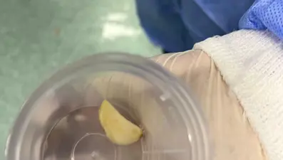 Akciğerine sarımsak kaçtı, ameliyat ile çıkarıldı