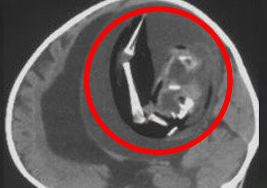 Bir yaşındaki kız çocuğunun beyninden doğmamış ikizi çıkarıldı 1