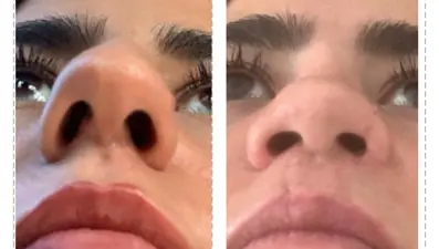 Avusturya'dan estetik için İstanbul'a gelen kadına yanlış 2 estetik yapıldı