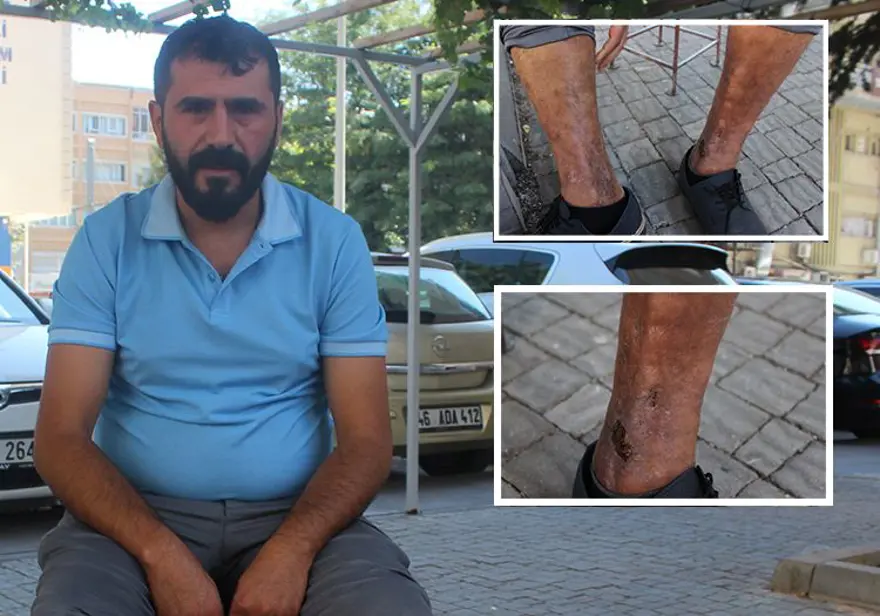 Sülük tedavisi hayatını kararttı! 2 aydır işe gidemiyor, yürümekte güçlük çekiyor 