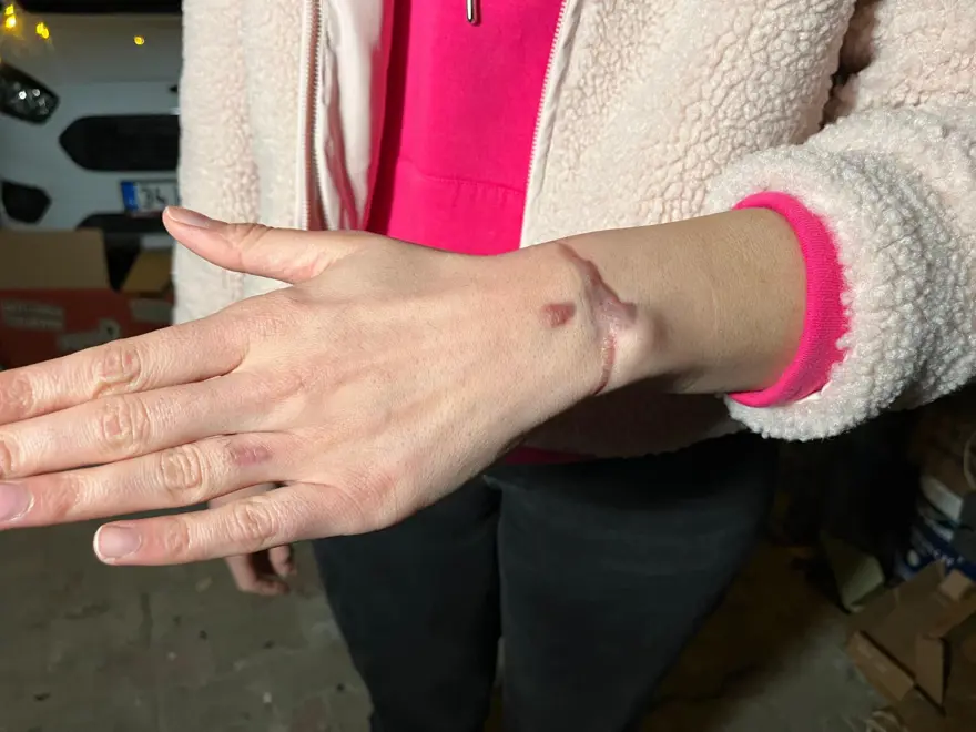 "ÜÇ SEANSTA KOLUMU YAKTILAR" 1