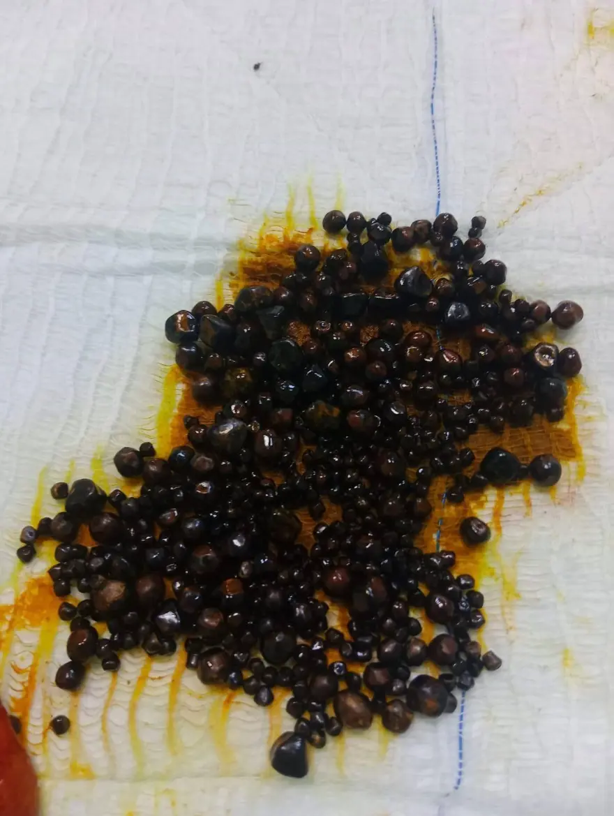Doktorlar bile şaşırdı: Hepsi safra kesesinden çıkarıldı 2