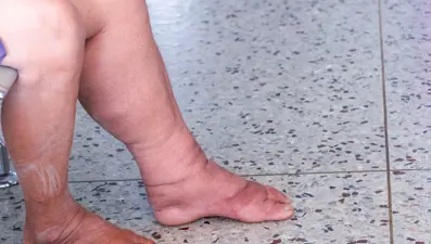 Fil ayağı hastalığı nedir, belirtiler nelerdir? Fil ayağı hastalığı neden olur?
