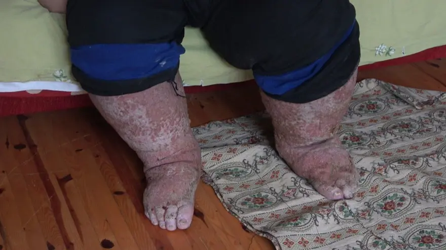 Sivrisinek ısırığı hayatını kararttı 3 Sivrisinek ısırığı hayatını kararttı 3